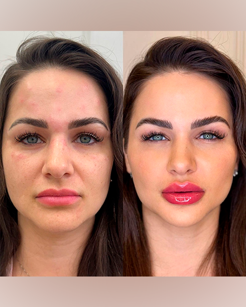 Caso 1 — Full Face Gold Premium