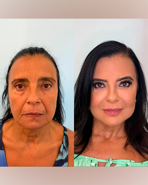 Caso 3 — Full Face Gold Premium