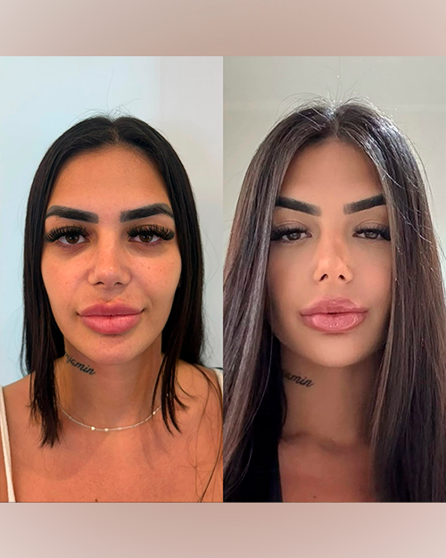 Caso 4 — Full Face Gold Premium