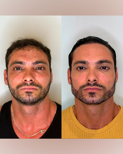 Caso 5 — Full Face Gold Premium