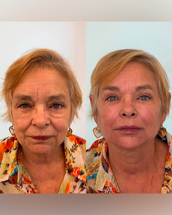 Harmonização Facial Full Face