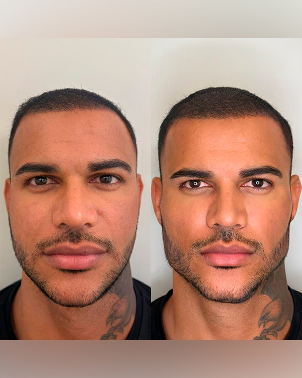 Harmonização Facial